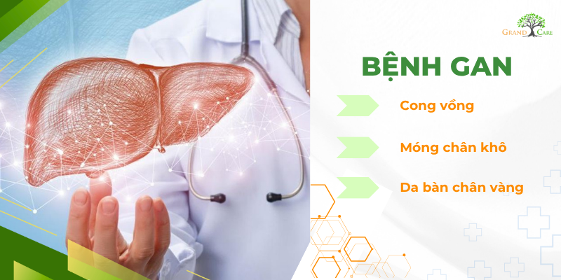 Bệnh gan – móng chân khô, cong vồng, da bàn chân vàng